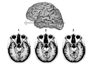 Brain scans of patient's amygdala damage